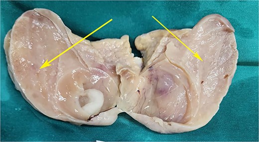 Postoperative specimen of the right ovarian cyst showing solid areas within (arrows).