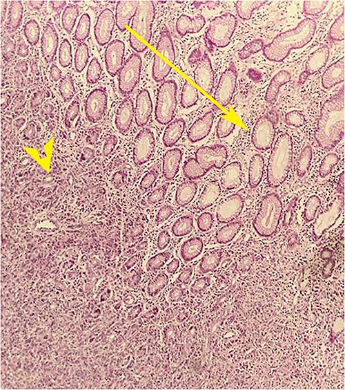 Postoperative histopathology H&E stain: 10× magnification showing tumour (arrow head) in the gastric wall pushing into the intact mucosa (arrow).
