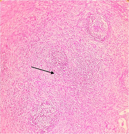Postoperative histopathology H&E stain: 40× magnification of tumour in the gastric wall showing signet cells and desmoplastic reaction.