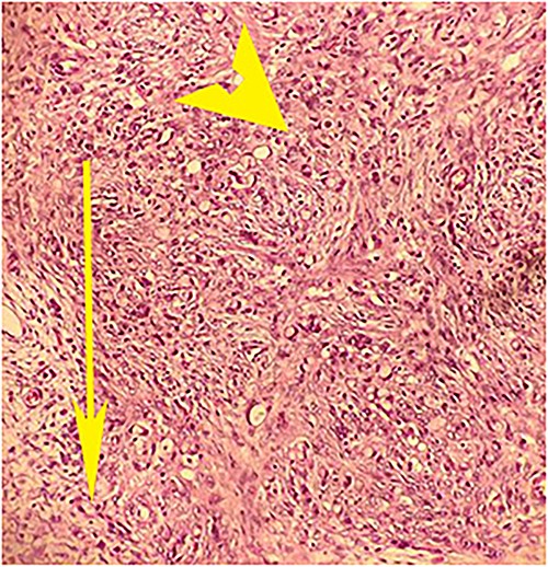 Postoperative histopathology H&E stain: 20× magnification of ovarian tissue showing tumour with signet cells (arrow head) and oedematous surrounding stroma (arrow).