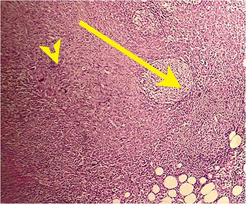 Postoperative histopathology H&E stain: 10× magnification of a representative perigastric lymph node showing tumour (arrow head) surrounding the germinal centres (arrow).