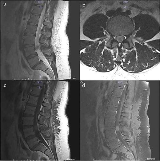 Preoperative MRI scans demonstrate a 17 × 12 × 15 mm intradural lesion posterior to the L3–4 disc and upper part of the L4 corpus. (a) The edge of the hypointense lesion is not so sharp in the midsagittal T2-weighted image. (b) In contrast to the sagittal T2-weighted image, the tumor appears to be hyperintense in the axial T2-weighted image. Because the nerve fibers are compressed by the tumor toward the dura CSF is not visible. (c) Midsagittal T1-weighted image shows a barely noticeable intradural tumor that is isointense with the vertebral body. (d) On midsagittal contrast-enhanced T1-weighted image, the tumor was homogeneously enhanced and became prominent.