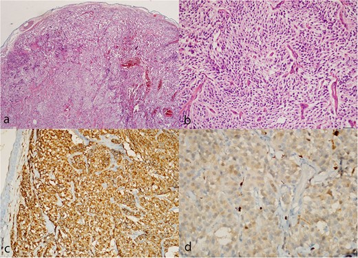 Paraganglioma histology. (a, b) Hematoxylin and eosin sections show a well-circumscribed tumor composed of uniform chief cells arranged in a typical acinar pattern (Zellballen). (c) Immunohistochemistry with the antibodies to chromogranin A highlights the chief cells. (d) Small sustentacular cells incompletely surround some acini, as highlighted with the S-100 antibody.