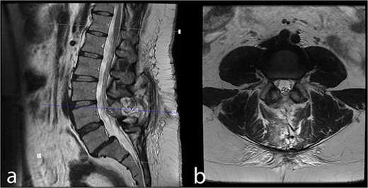 Forty-three month postoperative (a) midsagittal and (b) axial MRI images show no residual/recurrent intradural lesion.