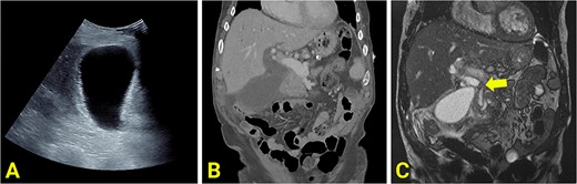 (A) Ultrasound scan showing a distended and enlarged gallbladder with a thickened wall suggestive of acute cholecystitis. No obvious gallstones are present. (B) Reconstructed contrast-enhanced coronal CT shows an enlarged and distended gallbladder, a thickened gallbladder wall, pericholecystic fluid, and a dilated common hepatic duct. (C) MRCP showing an obstructed gallstone at the confluence of the common hepatic duct, common bile duct and cystic duct (marked with arrow).