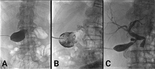 (A) Initial cholecystogram showing contrast filling the gallbladder. (B) Subsequent cholecystogram showing diffuse filling defects consistent with clot in the gallbladder and cystic duct. (C) Final cholecystogram after the use of alteplase showing resolution of clots and contrast flowing into the biliary tree.