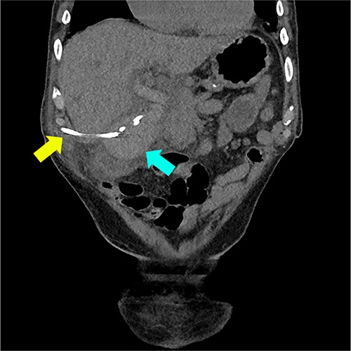 Coronal CT reconstruction showing high density material within the lumen of the gallbladder suggestive of haemorrhage (marked with blue arrow) and cholecystostomy tube (marked with yellow arrow).
