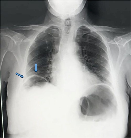 Appearance of pneumoperitoneum beneath the right diaphragmatic dome.