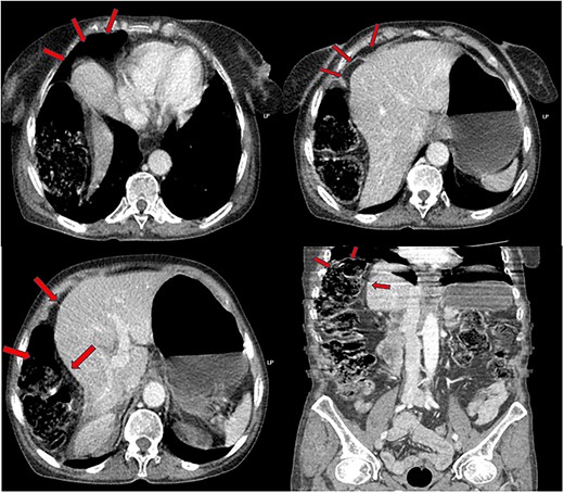 Interposition of the right colic angle and a part of the ascending colon, between the right diaphragm and the liver (image of pseudo-pneumoperitoneum).