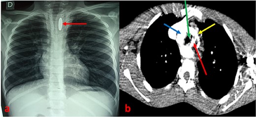 (a) Chest X-ray showing an opacity related to a metallic foreign body in an enlarged mediastinum with narrowing of the thoracic trachea. (b) CT scan section showing a metallic foreign body embedded in the esophagus associated with a double aortic arch. Arrows: red (esophageal foreign body), blue (right arch), green (trachea), and yellow (left arch).