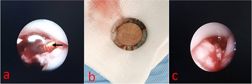(a) Endoscopic view of esophageal foreign body. (b) 250FCFA coin. (c) Endoscopic view of the posterior esophageal wall.