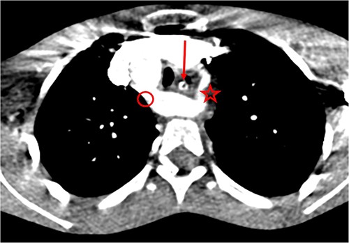 Double aortic arch on thoracic angio-CT scan: arrow (esophagus), star (left arch), circle (right arch).