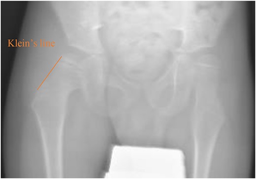 Pelvic anterior–posterior radiograph showing coxa valga deformity in the left hip.
