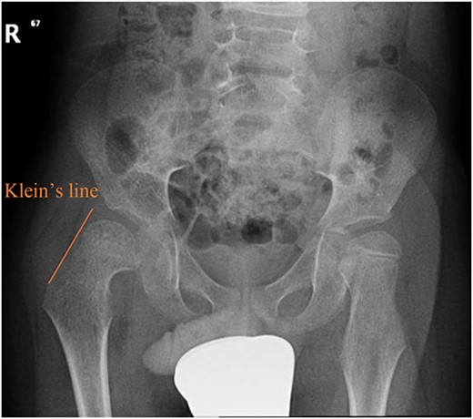 Pelvic anterior–posterior radiograph showing SCFE in the right hip, with Klein’s line not intersecting the capital femoral epiphysis