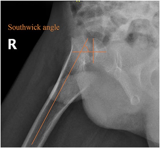 Pelvic frog-leg lateral view radiograph showing Southwick’s slip angle 50° in the right hip.
