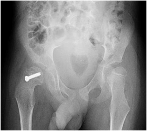 Pelvic anterior–posterior radiograph immediately after in situ fixation with single cannulate screw.
