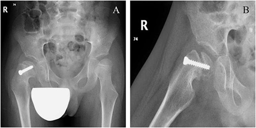 Six weeks following post-operative fixation: (A) pelvic anterior–posterior radiograph and (B) pelvic frog-leg lateral view radiograph.