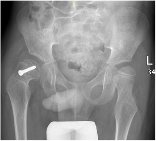 Pelvic anterior–posterior radiograph, 3 months following post-operative fixation.
