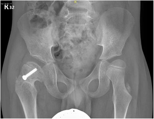 Pelvic anterior–posterior radiograph, 15 months following post-operative fixation.