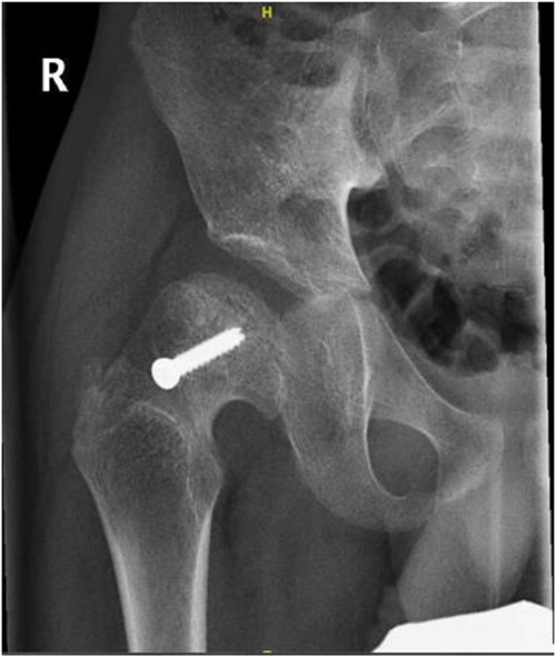 Right hip anterior–posterior radiograph, 36 months following post-operative fixation.