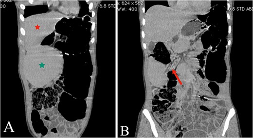 (A and B) The coronal plane of the abdominal CT reveals the liver (A, red star) and the WS in the right upper quadrant (A, green star), with torsion evident in the splenic mesentery (B, arrow).