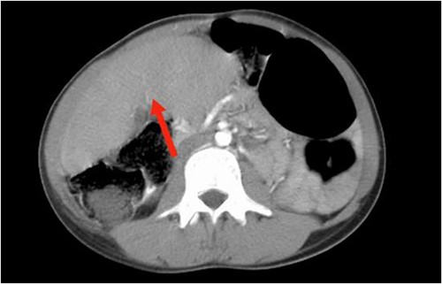 The axial plane of the abdominal CT reveals the spleen in the right upper quadrant.