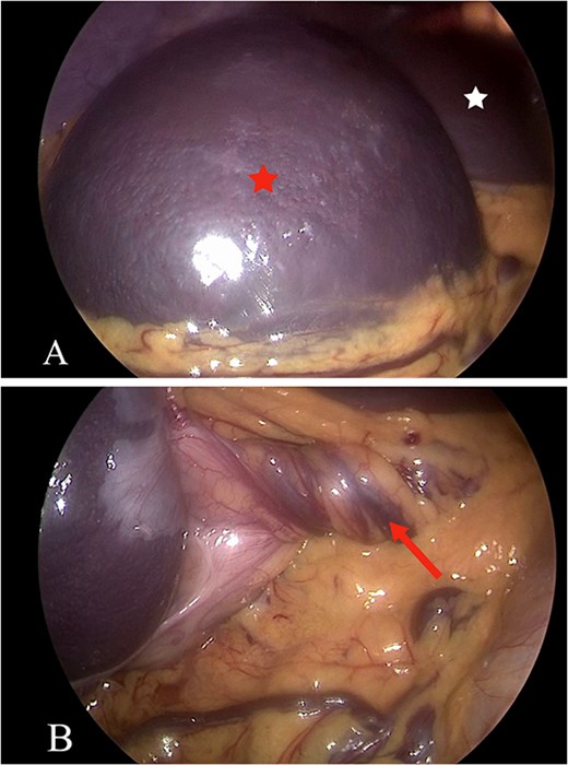 (A and B) The laparoscopic view shows the spleen (A, red star) and the liver (A, white star), revealing torsion in the spleen mesentery (B, arrow).
