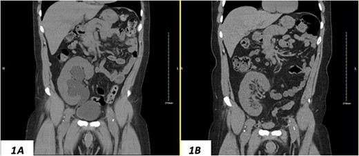 (A) Hydronephrosis of the allograft ureter on preoperative coronal CT scan; (B) significant improvement of hydronephrosis on the 10-month postoperative image.