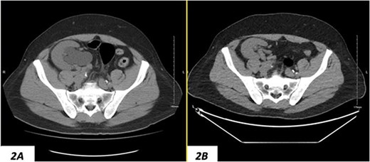 (A) Hydronephrosis of the allograft ureter on preoperative cross-sectional CT scan; (B) significant improvement of hydronephrosis on the 10-month postoperative image.