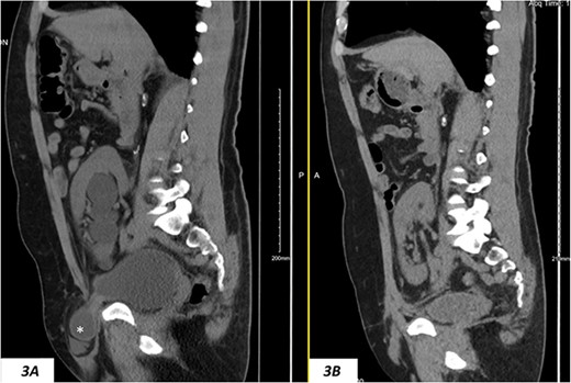 (A) Hydronephrosis on preoperative sagittal CT scan showing the reported dilated part of the distal ureter (*), which was correctly identified intraoperatively as a sliding dome of the bladder; note the relationship to the pubic bone; (B) significant improvement of hydronephrosis on the 10-month postoperative image.