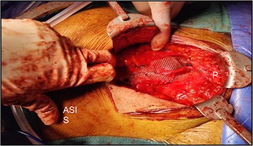 Intraoperative picture showing light polypropylene mesh in Lichtenstein-like fashion of repair; please note the relative location of the pubic bone (P) and the anterior superior iliac spine (ASIS).
