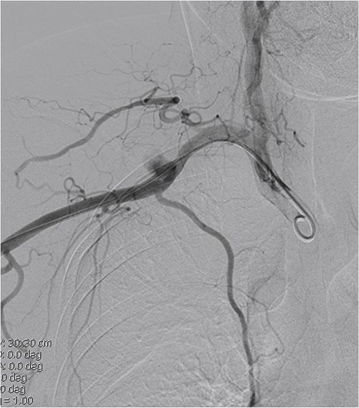DSA indicates an axillary artery pseudoaneurysm.
