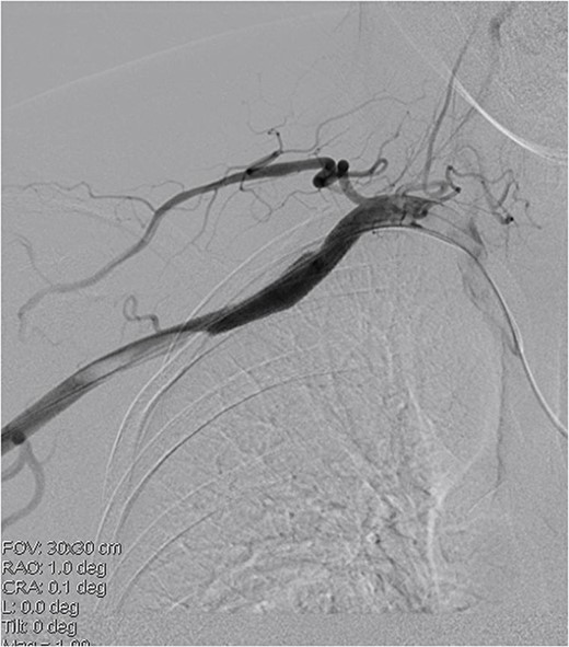 Covered stent placement isolates the pseudoaneurysm rupture, and further thrombectomy treatment is planned.