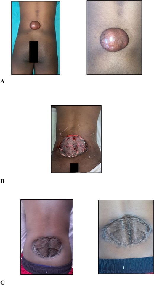 (A) Clinical photographs of the 6.0 × 5.0 × 3.0-cm hyperpigmented, spherical, firm, smooth, mobile nodule to the midline of the lower back 5.0 cm cranial to the natal cleft; (B) clinical photographs of the skin-grafted lower back at 3 days after surgery; (C) clinical photographs of the skin-grafted lower back at 6-month follow-up after surgery.