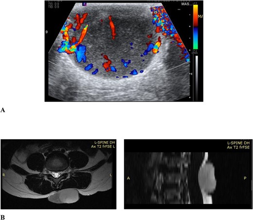 (A) Ultrasound scan of the lesion to the lower back with doppler showing vascular flow; (B) MRI scan of the lesion to the back showing it extending to the level of the erector spinae fascia but not crossing it and no tract to the spinal canal, in the axial and sagittal planes, respectively.