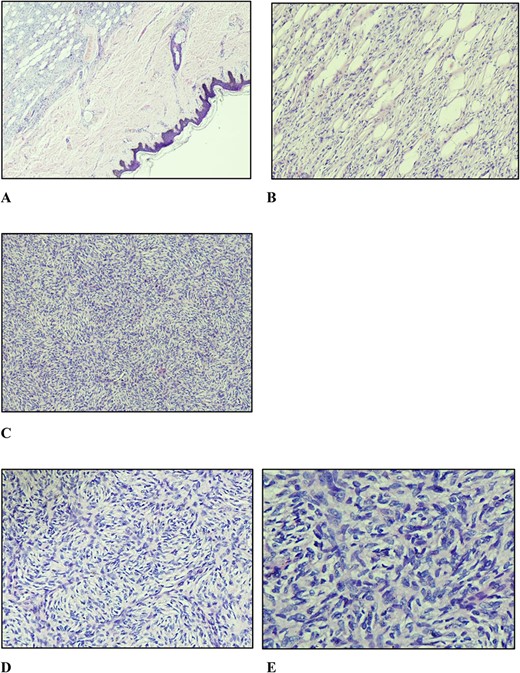(A) Nodular vaguely circumscribed spindle cell proliferation centred in the subcutis with intact overlying skin (×40); (B) spindle cell proliferation interdigitating the adipose tissue resulting in a honeycomb pattern (×100); (C and D) spindle cells showing the typical storiform pattern of growth (×100 and ×200); (E) slender fibroblastic tumour cells displaying elongated wavy nuclei with mild to minimal atypia.
