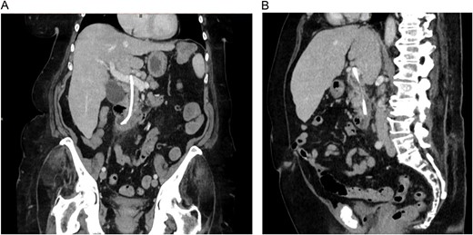 CT images showing the migrated common bile duct stent in the portal vein. (A) Coronal view. (B) Sagittal view.