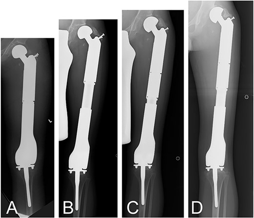 A 5-year-old boy presented with osteosarcoma of the left distal femur. After the tumor was resected, the defect was reconstructed by a recycled frozen autograft. The recycled bone was fractured, and total femoral replacement with the Stryker Growth Prosthesis was required when he was 8 years old (A). By 11 years of age his femur was extended by 80 mm (B). The extension was reduced to 0 mm, and 60-mm spacer was added (C), and then the Stryker Growth Prosthesis was further extended, resulting in a total of 122 mm of expansion from the time of initial total femoral replacement by the age of 13 years (D).