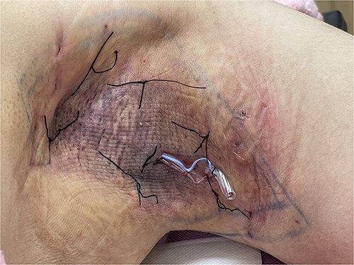The seroma was treated with quilting suture and Penrose drain placement. The quilting suture approximated the skin flap to the underlying tissues to reduce dead space and promote fluid reabsorption, while the Penrose drain directly drained accumulated fluid from the seroma cavity.