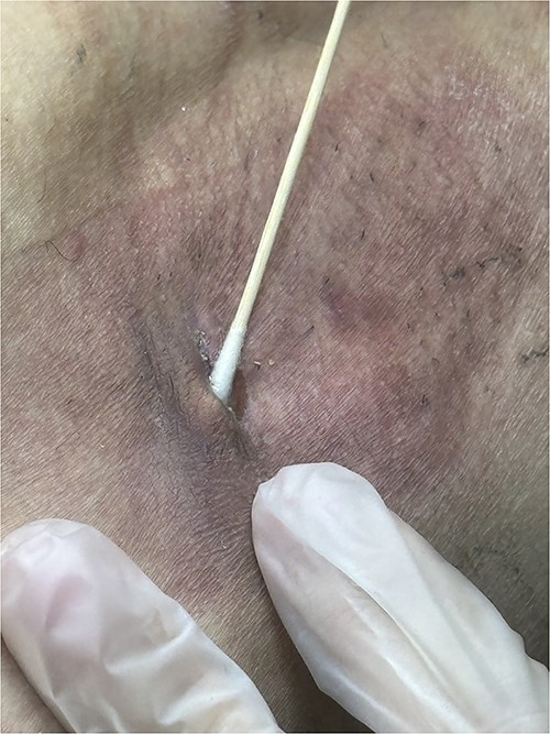 The seroma responded to silver nitrate treatment. A second application of silver nitrate, applied using ENT cotton swab, resulted in complete seroma resolution within 14 days. This figure demonstrates the efficacy of silver nitrate in treating seroma.