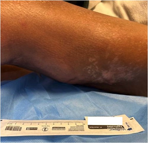 The posterolateral thigh at admission to our tertiary facility.