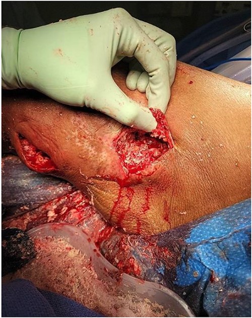 Initial incision, drainage, and debridement of the wound showing extensive coral-like calcifications in conjunction with thick milky non-odorous fluid.
