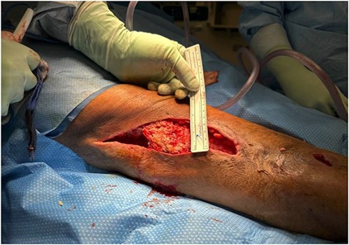 The remaining intact calcified mass before excision.