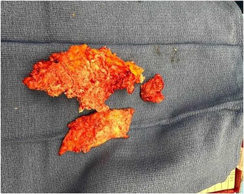 The excised calcified tissue measuring 17 × 8 × 4 cm.