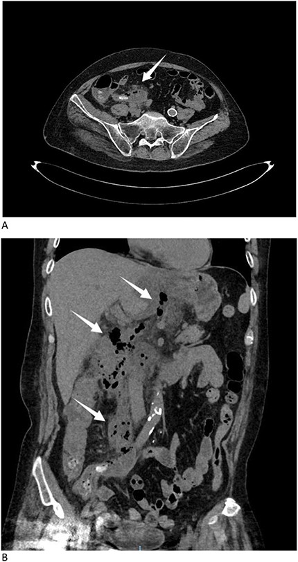 (A) CT scan identified an appendicolith with diffuse infiltration (arrow). (B) CT scan showed a large amount of gas in the retroperitoneal space, extending from the cecum along the mesentery to the stomach (arrows).