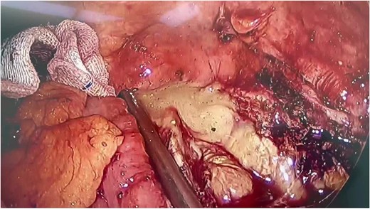 During the operation, a significant accumulation of pus was revealed.