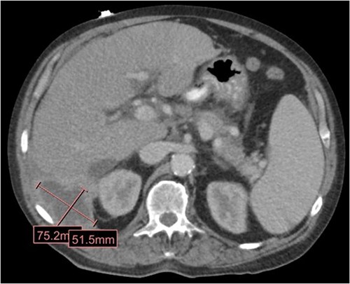 CT in the transverse plane demonstrating a perihepatic gallstone-containing collection of fluid measuring up to 7.5 × 5.1 cm.