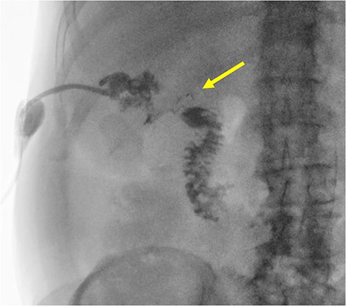 A radiographic fistulogram demonstrating the fistulous tract communicating with the second part of the duodenum.