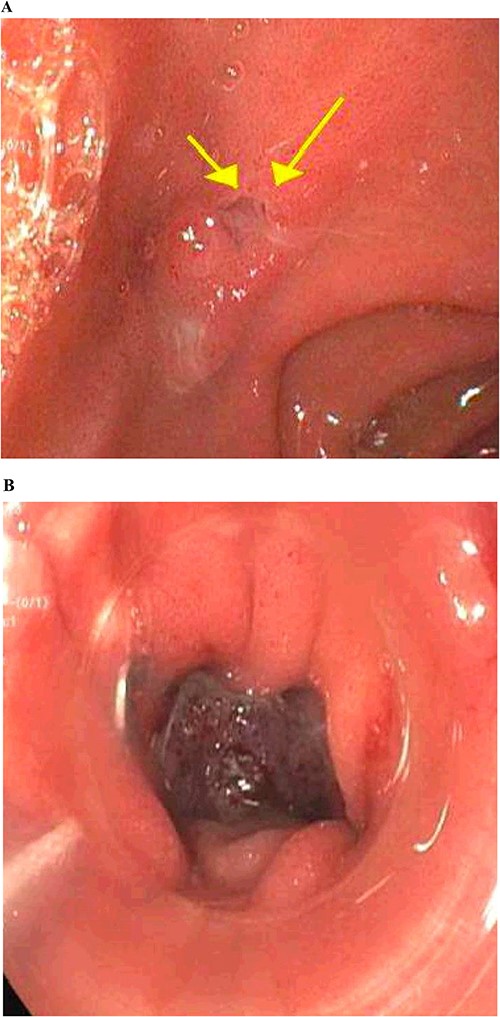 Gastrointestinal endoscopy. (A) Fistula defect found in the duodenal bulb. (B) Endoscopic closure using the over-the-scope clip system.