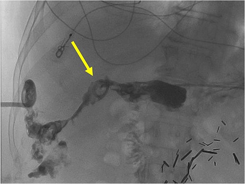 A radiographic fistulogram demonstrating the fistulous tract communicating with the proximal duodenum/gastric pylorus.